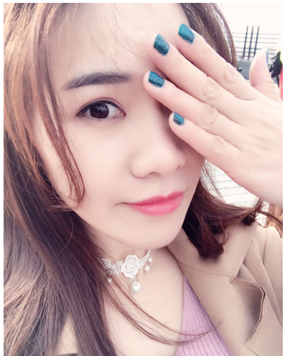 營口臻美醫(yī)療整形醫(yī)生閆迎軍做雙眼皮效果怎么樣？附雙眼皮案例對(duì)比圖