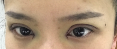 長春麥西美嘉整形醫(yī)生王圣博做雙眼皮手術(shù)效果怎么樣？附雙眼皮案例