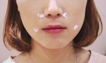 信陽東方藝美容醫(yī)院劉力萌做玻尿酸去法令紋效果怎么樣？附案例效果對比圖