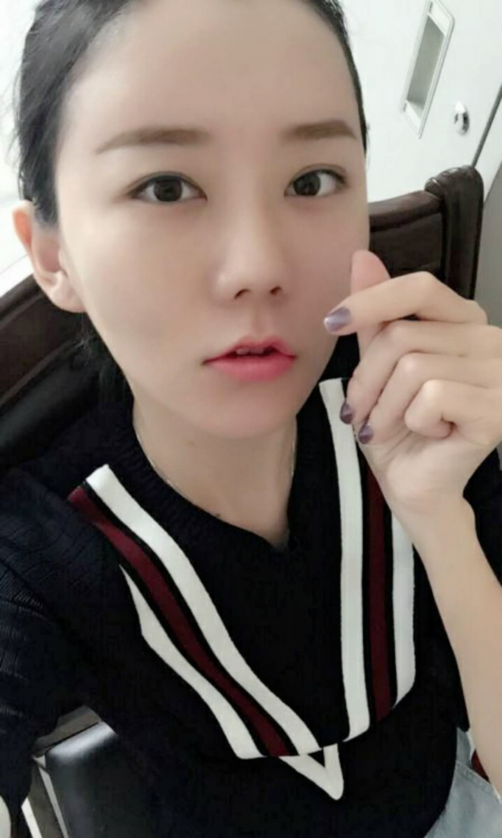 沈陽(yáng)友誼整形美容醫(yī)院金顕哲醫(yī)生做自體脂肪填充臉部+V-LINE瓜子臉手術(shù)案例效果圖