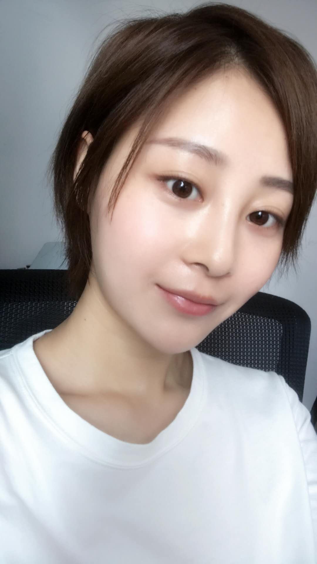 天津歐華威莎整形醫(yī)生姚玲做面部埋線提升效果怎么樣？附埋線提升案例