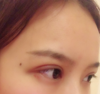 長春麥西美嘉整形醫(yī)生王圣博做雙眼皮手術(shù)效果怎么樣？附雙眼皮案例