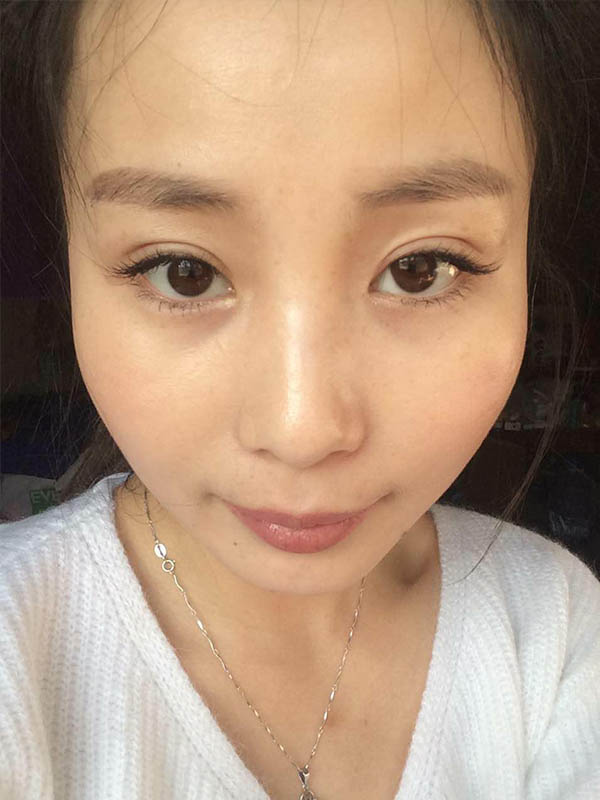 桂林新華醫(yī)療美容醫(yī)生李新華做雙眼皮手術(shù)怎么樣？李新華雙眼皮手術(shù)案例