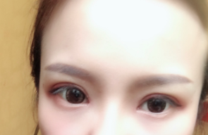 長(zhǎng)春麥西美嘉整形醫(yī)生王圣博做雙眼皮手術(shù)效果怎么樣？附雙眼皮案例