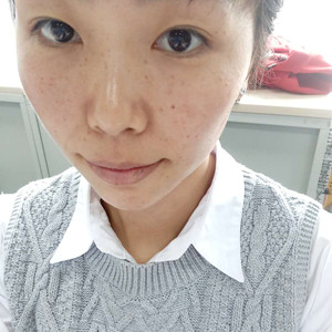 珠海蒂伊醫(yī)療整形醫(yī)生廖俊凱做激光祛斑效果怎么樣？附激光祛斑案例效果圖