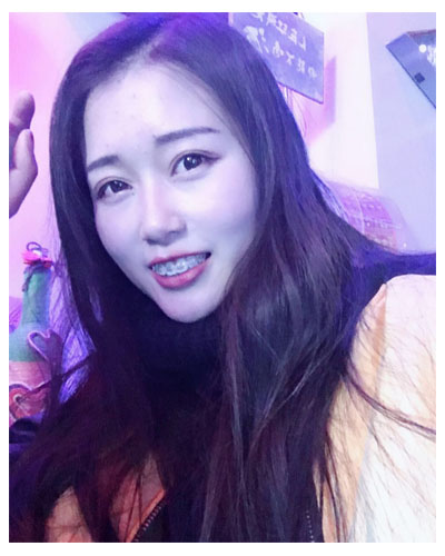 義烏傅氏口腔醫(yī)生朱雨晴做牙齒隱形矯正效果怎么樣？附牙齒隱形矯正案例
