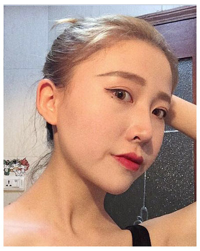 珠海海大整形美容外科黃發(fā)醫(yī)生做面部吸脂怎么樣？附面部吸脂案例