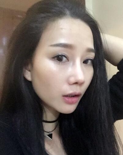 西安陽光整形醫(yī)院邵萍醫(yī)生做鼻綜合整形怎么樣？附鼻綜合整形案例