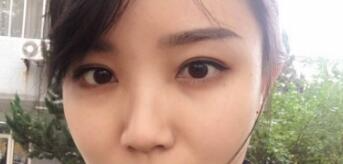 長(zhǎng)沙微笑醫(yī)療整形醫(yī)生段雙軍做切開雙眼皮+開內(nèi)眼角效果怎么樣？附案例