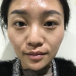石家莊雅芳亞整形醫(yī)生王文明做雙眼皮+開眼角+鼻綜合整形案例效果對比圖