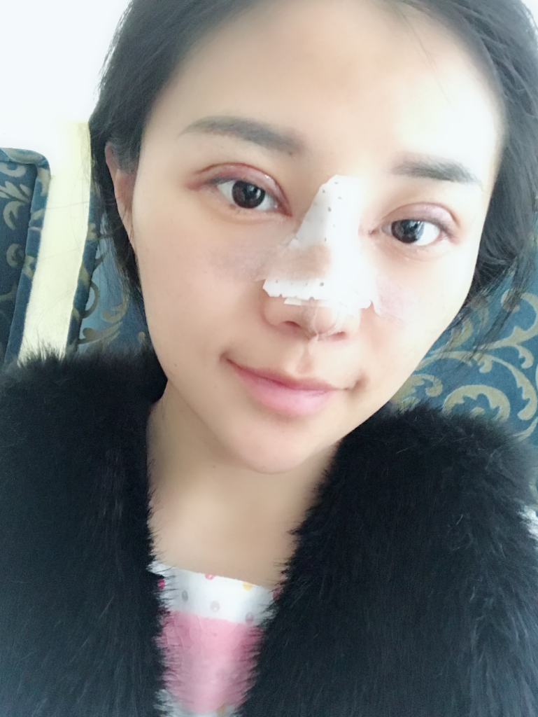 石家莊雅芳亞整形醫(yī)生王文明做雙眼皮+開眼角+鼻綜合整形案例效果對(duì)比圖