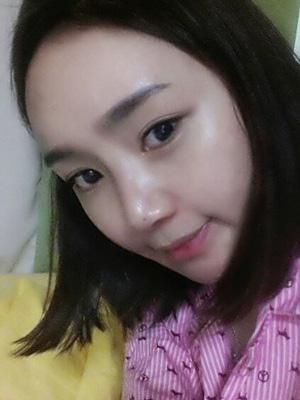 長春中妍整形醫(yī)院吳學(xué)軍醫(yī)生做玻尿酸墊下巴+玻尿酸豐太陽穴案例效果對(duì)比圖