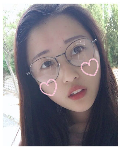 義烏傅氏口腔醫(yī)生朱雨晴做牙齒隱形矯正效果怎么樣？附牙齒隱形矯正案例