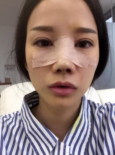 西安陽光整形醫(yī)院邵萍醫(yī)生做鼻綜合整形怎么樣？附鼻綜合整形案例
