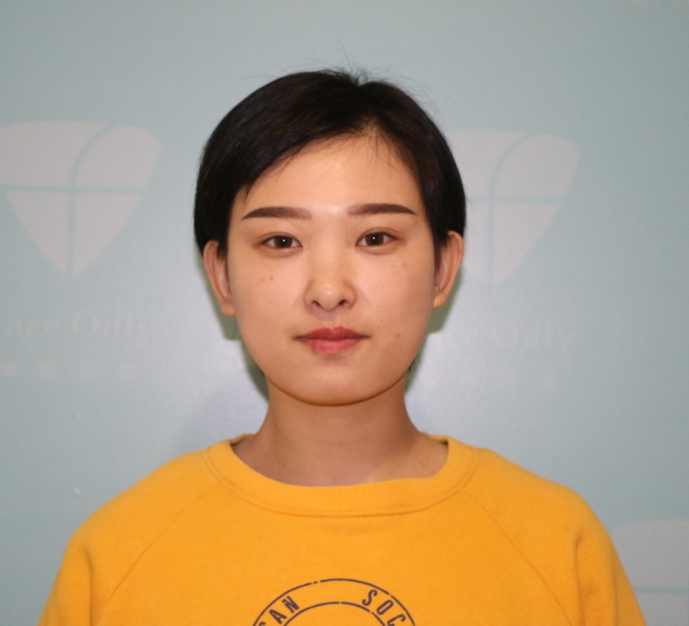 武漢肽慕醫(yī)美整形醫(yī)院楊婉菱醫(yī)生做面部吸脂效果怎么樣？附面部吸脂案例