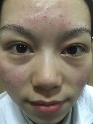 西安壹加壹整形醫(yī)院劉晨醫(yī)生做點(diǎn)陣激光祛痘效果怎么樣？附點(diǎn)陣激光祛痘效果圖