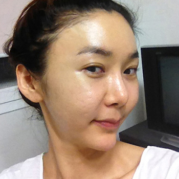 周口華美整形醫(yī)院翟紅光醫(yī)生做面部除皺效果怎么樣？附案例效果對比圖