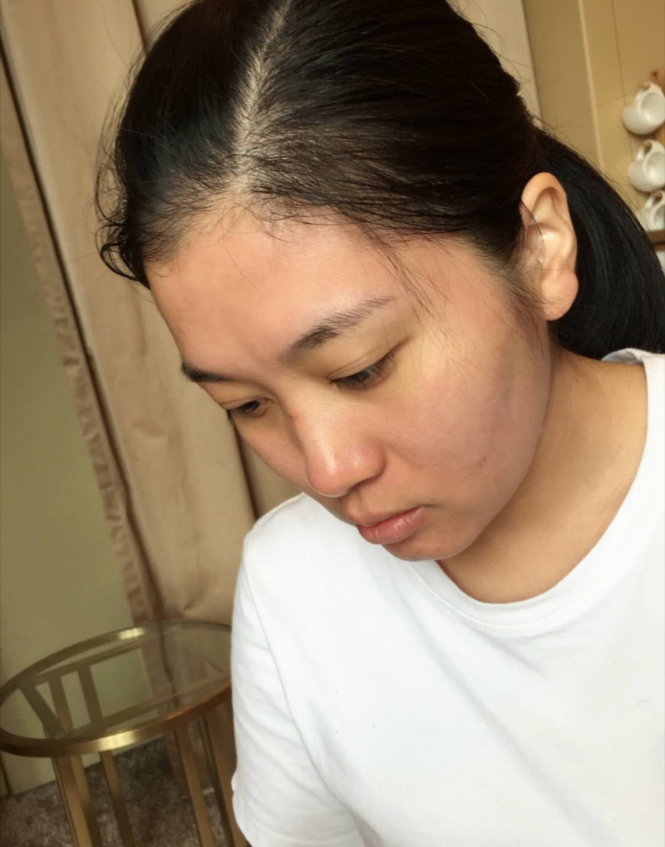 哈爾濱禾力康整形醫(yī)院劉亞春醫(yī)生做點陣激光去痘印效果怎么樣？附案例