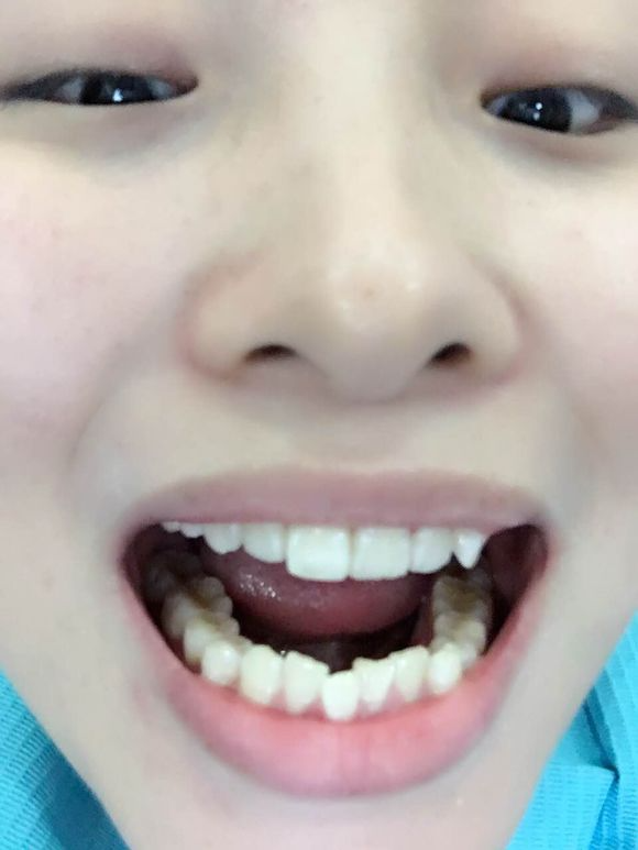 重慶齊美口腔周映丞醫(yī)生做牙齒隱形矯正怎么樣？附牙齒隱形矯正案例