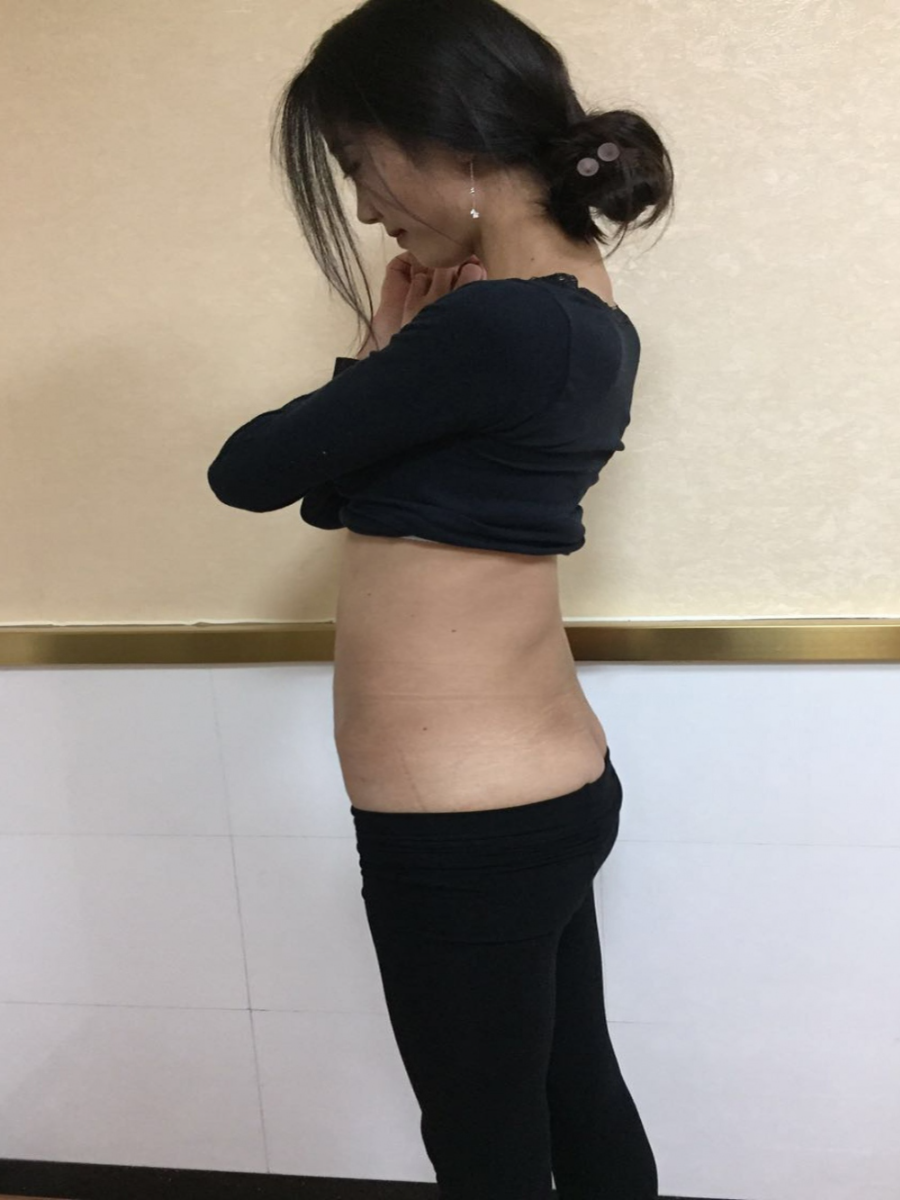 北京東方瑞麗整形醫(yī)生夏兆驥做腰腹吸脂效果怎么樣？附腰腹吸脂案例效果對(duì)比圖