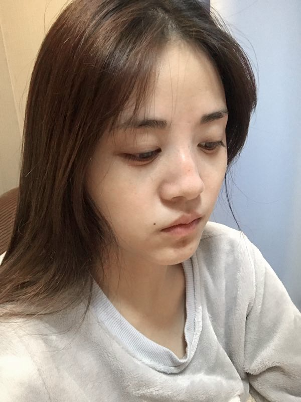 駐馬店締萊美醫(yī)療整形醫(yī)生李冰做鼻綜合整形怎么樣？附鼻綜合整形案例效果對比圖