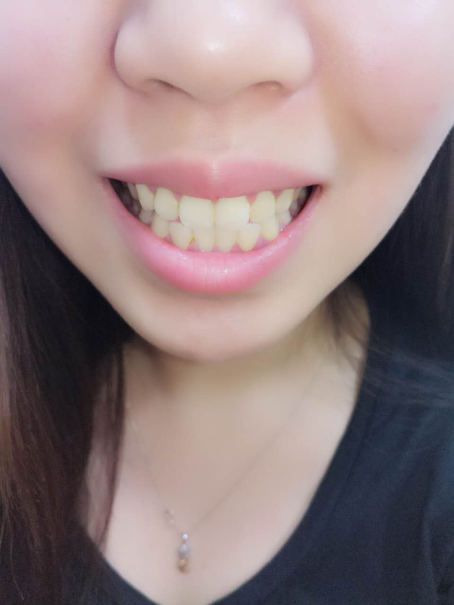杭州國雅口腔醫(yī)院張虹醫(yī)生做冷光美白效果怎么樣？附冷光美白案例效果對比圖