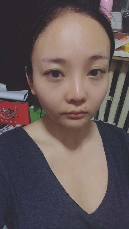 北京可思美醫(yī)療整形醫(yī)生蘇靜做臉部自體脂肪填充效果怎么樣？