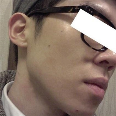 浙江綠城醫(yī)院整形美容中心丁路醫(yī)生做激光祛痘效果怎么樣，附案例對比圖