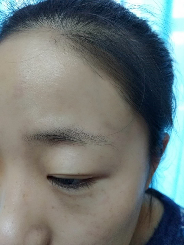 長(zhǎng)沙愛(ài)思特醫(yī)療美容醫(yī)院做半永久紋眉怎么樣？附彭子娟醫(yī)生案例效果圖