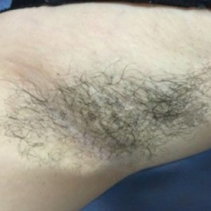 廈門張銘整醫(yī)療整形醫(yī)生張小玲做激光脫腋毛怎么樣？附激光脫腋毛效果對(duì)比圖