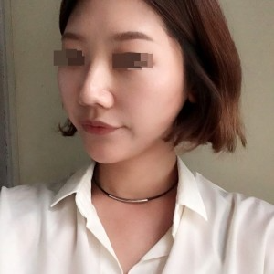 太原麗都整形醫(yī)院劉晉艷醫(yī)生做光纖溶脂瘦臉怎么樣？附案例效果對比圖