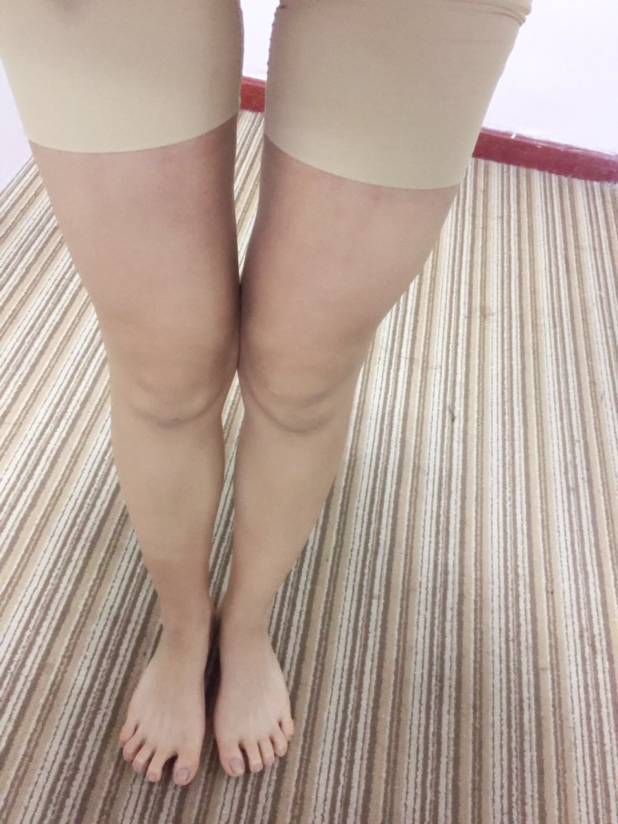 北京蒂凡妮整形靳玉彪醫(yī)生做大腿吸脂怎么樣？附大腿吸脂案例效果對(duì)比圖