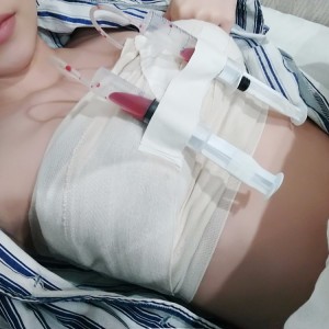 廣州廣大整形美容醫(yī)院醫(yī)生查旭山做假體隆胸怎么樣？附案例