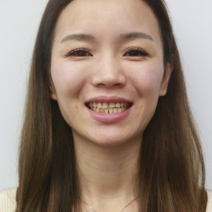 安慶渡江口腔醫(yī)院張良斌醫(yī)生牙齒貼面怎么樣？附牙齒貼面效果圖