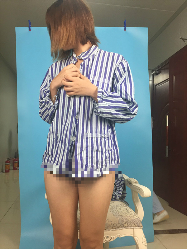 北京蒂凡妮整形靳玉彪醫(yī)生做大腿吸脂怎么樣？附大腿吸脂案例效果對(duì)比圖