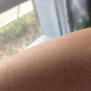 鄭州屈小麗醫(yī)療整形醫(yī)院醫(yī)生劉丹做手臂脫毛怎么樣？附手臂脫毛案例