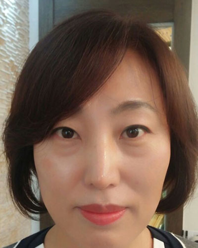北京四季美學(xué)炫美整形醫(yī)生高玲做埋線祛眼袋怎么樣？附案例效果對(duì)比圖