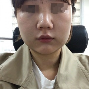太原麗都整形醫(yī)院劉晉艷醫(yī)生做光纖溶脂瘦臉怎么樣？附案例效果對比圖