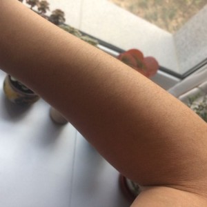 鄭州屈小麗醫(yī)療整形醫(yī)院醫(yī)生劉丹做手臂脫毛怎么樣？附手臂脫毛案例