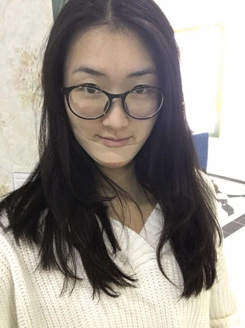武漢中翰整形外科醫(yī)院做硅膠墊下巴怎么樣？附朱紅霞醫(yī)生案例效果對比圖