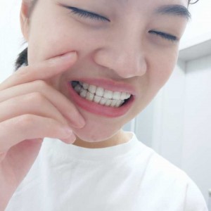 廈門拜博口腔醫(yī)院醫(yī)生張忠做牙齒隱形矯正怎么樣？附案例效果對比圖