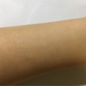 鄭州屈小麗醫(yī)療整形醫(yī)院醫(yī)生劉丹做手臂脫毛怎么樣？附手臂脫毛案例