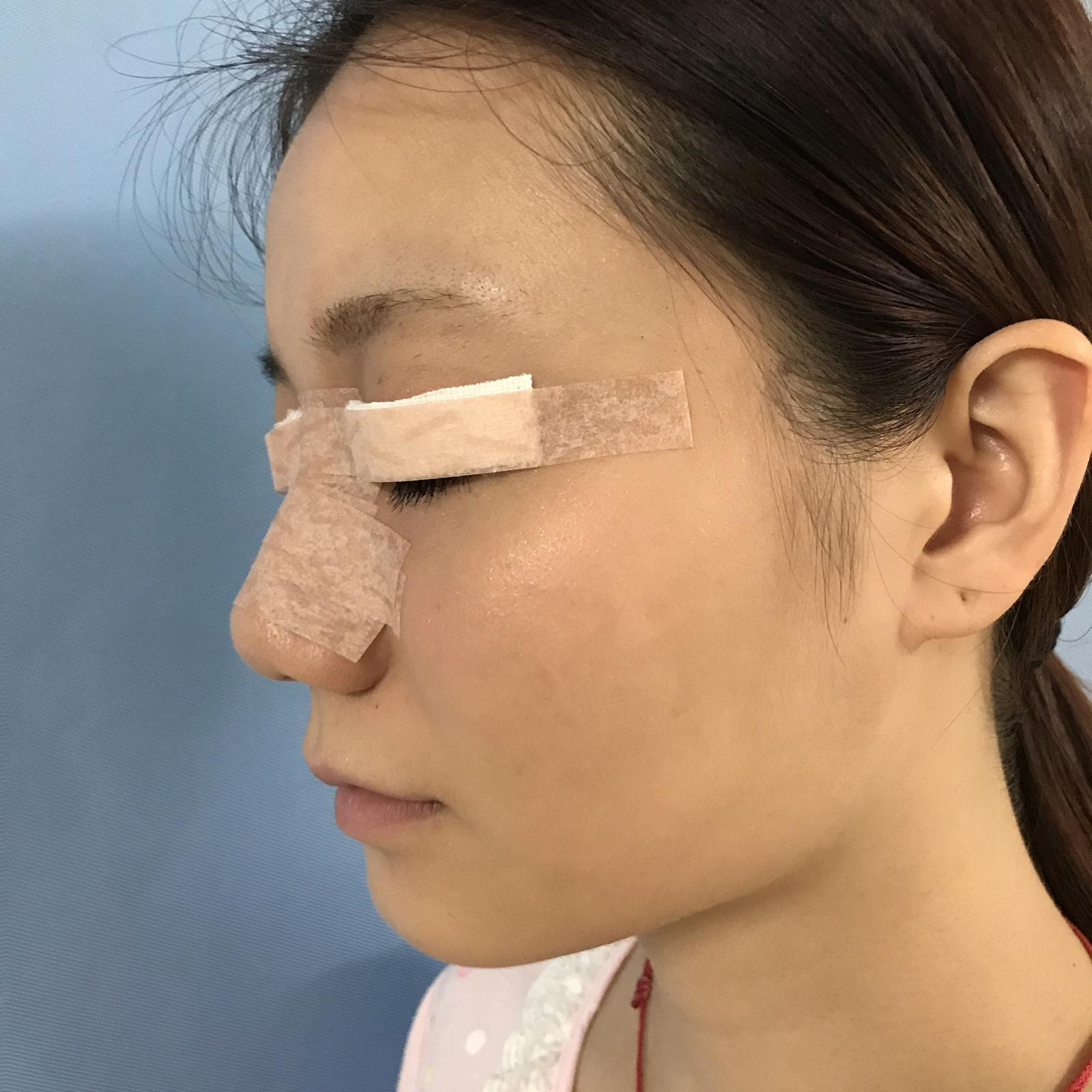 武漢華美整形醫(yī)院醫(yī)生王向陽做眼綜合整形怎么樣？附案例效果圖