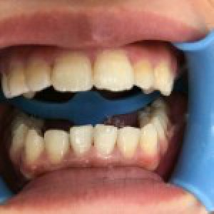 洛陽友好口腔醫(yī)院醫(yī)生楊愛芳做牙齒冷光美白怎么樣？附案例效果圖
