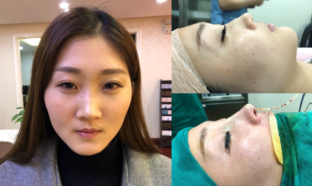 上海首爾麗格醫(yī)療美容醫(yī)院醫(yī)生樸晟秀做膨體隆鼻怎么樣？附案例效果圖