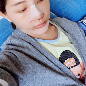 北京京民醫(yī)院整形外科醫(yī)生李鴻儒做硅膠隆鼻怎么樣？附案例效果圖