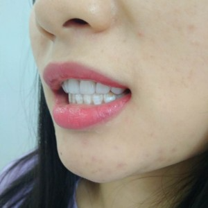 洛陽友好口腔醫(yī)院醫(yī)生李新然做牙貼面怎么樣？附案例效果圖