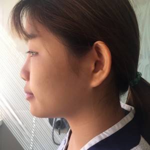 北京京民醫(yī)院整形外科醫(yī)生李鴻儒做硅膠隆鼻怎么樣？附案例效果圖