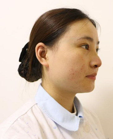 深圳陽光整形美容醫(yī)院醫(yī)生張平做膨體隆鼻+雙眼皮+注射瘦臉案例效果對比圖