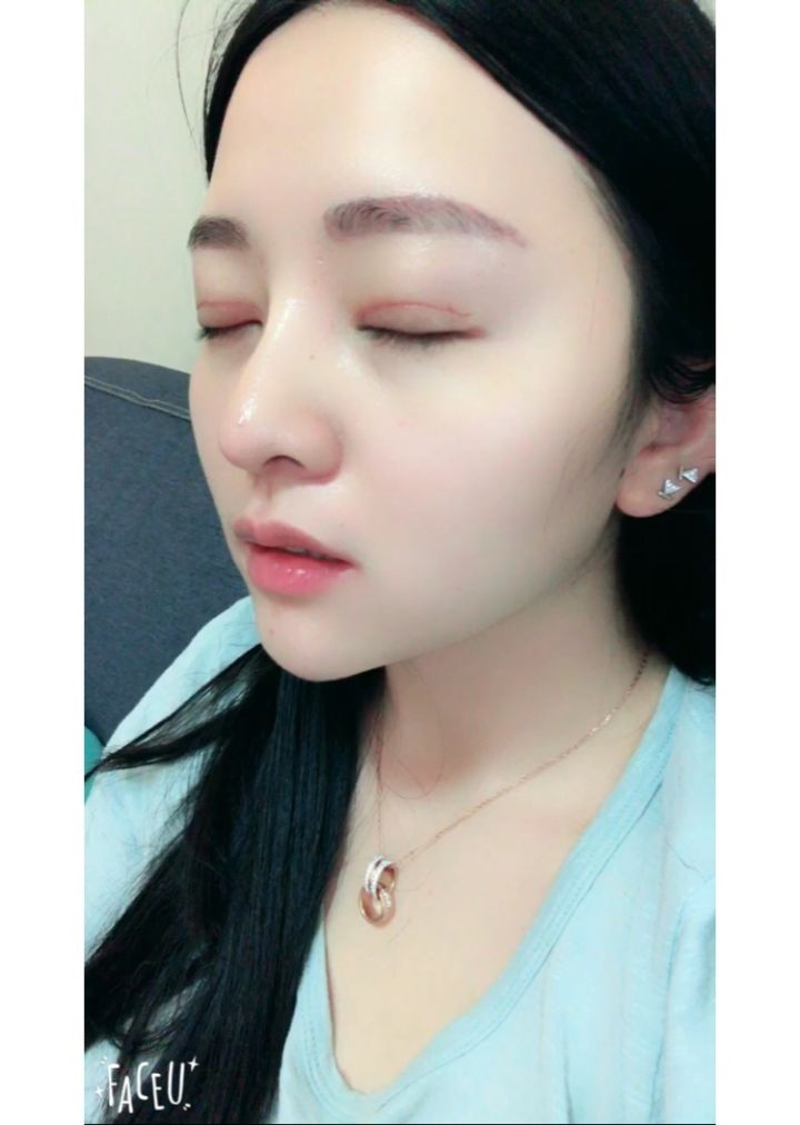 北京京韓整形醫(yī)生王義山做埋線雙眼皮怎么樣？附案例效果對(duì)比圖